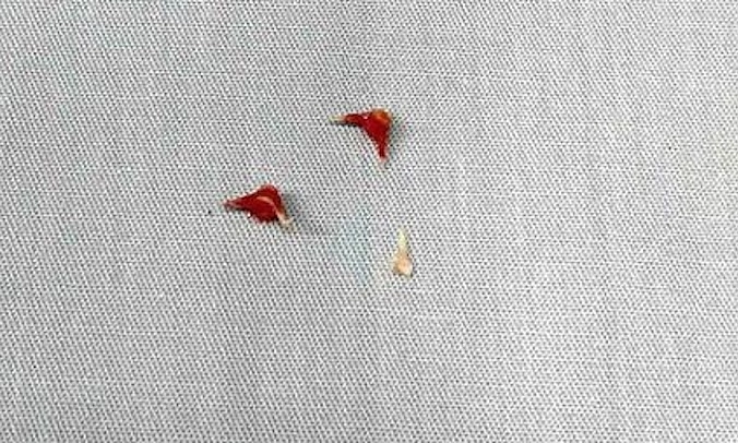 Bé 7 tháng tuổi phải thở máy vì xương lươn găm sâu đường thở