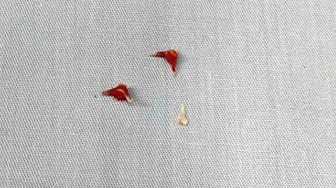 Bé 7 tháng tuổi phải thở máy vì xương lươn găm sâu đường thở