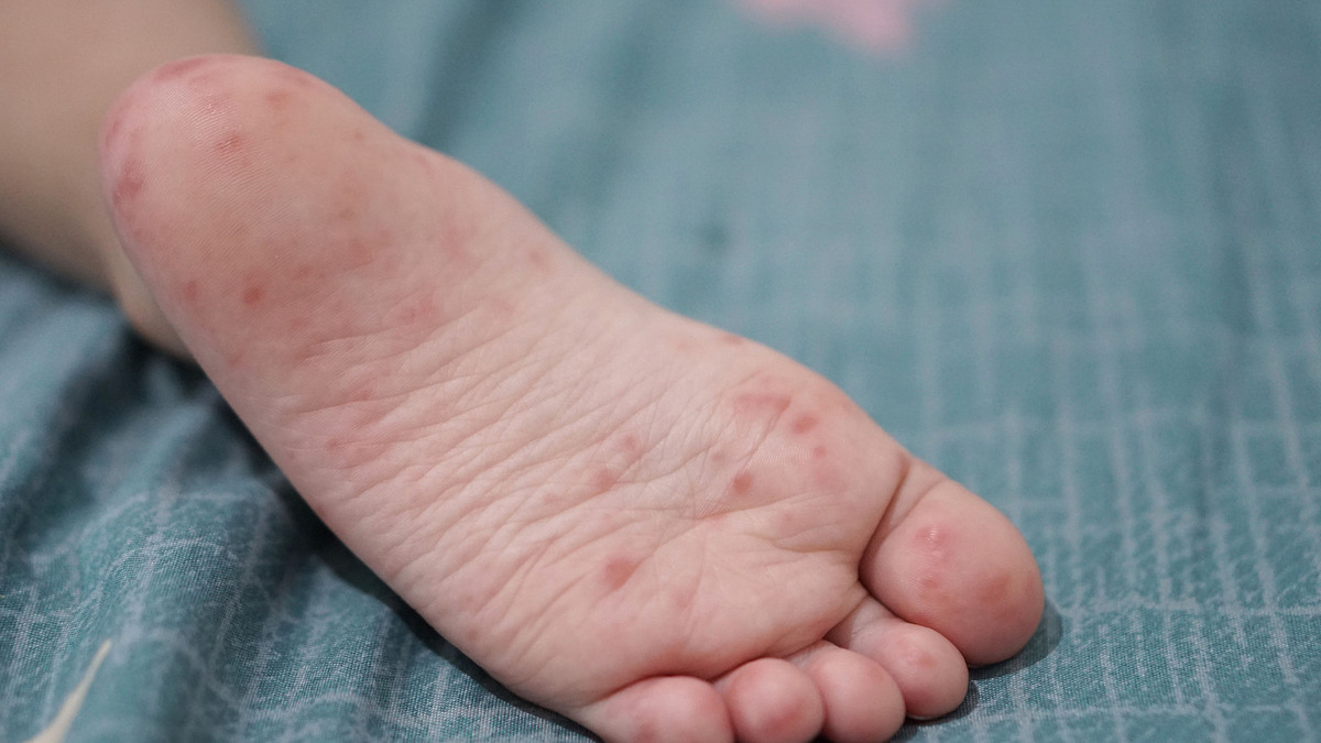 Mắc tay chân miệng lần hai có nhẹ hơn lần đầu?
