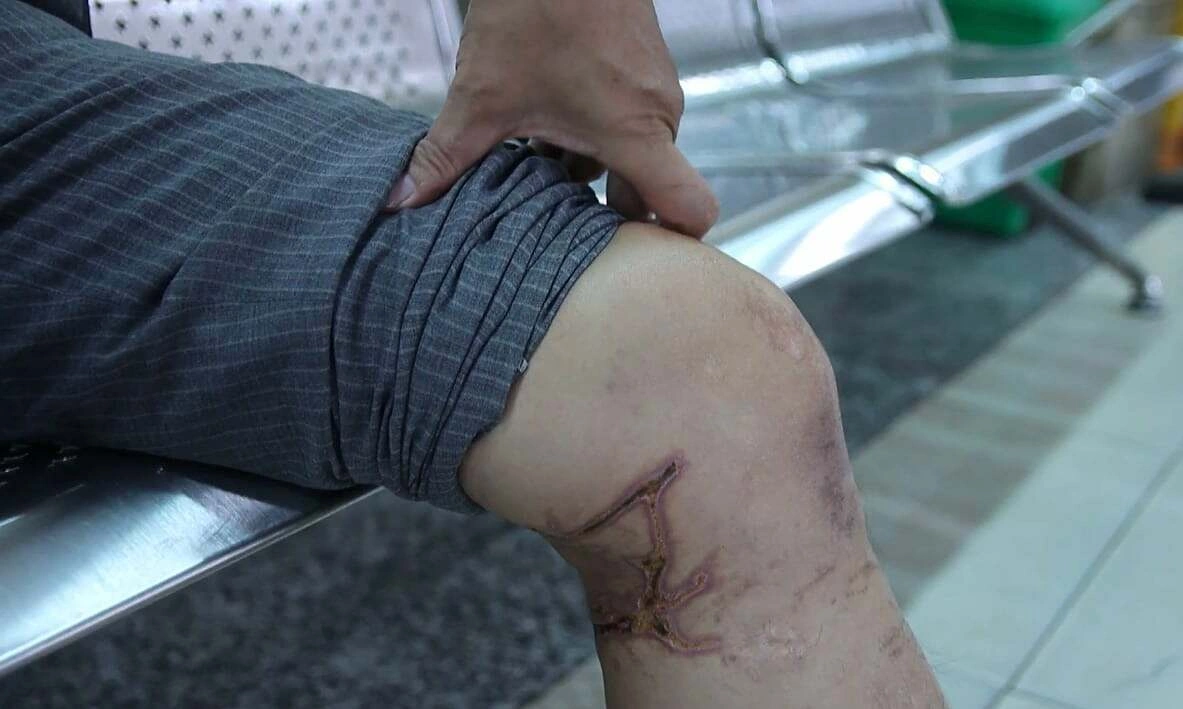 Sứa 'cắn' có phải tiêm uốn ván không?