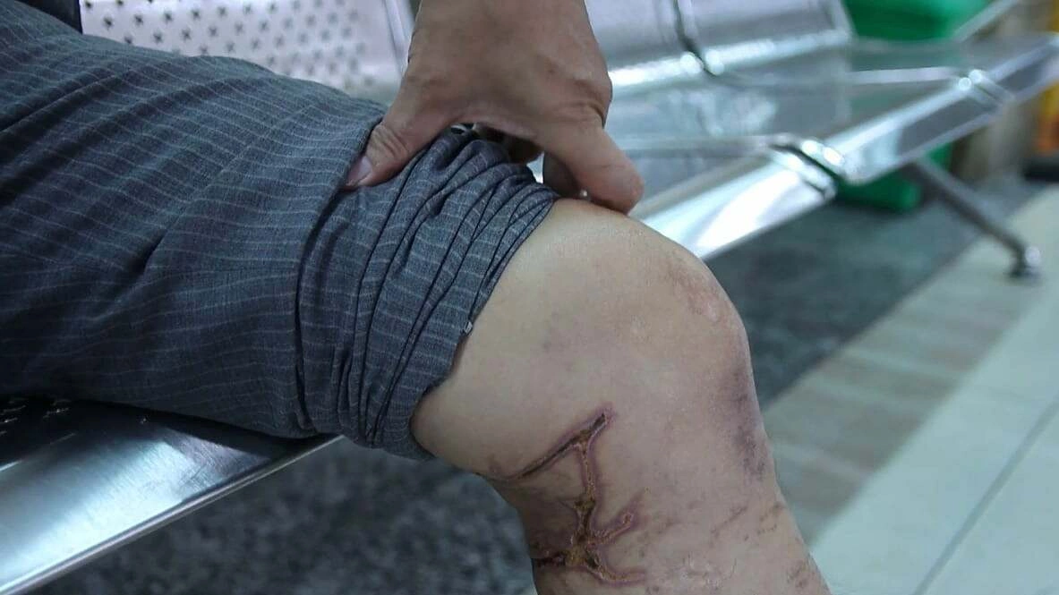 Sứa "cắn" có phải tiêm uốn ván không?