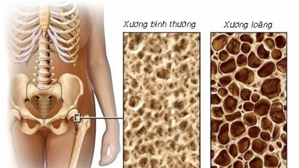 Ai cần đo loãng xương?
