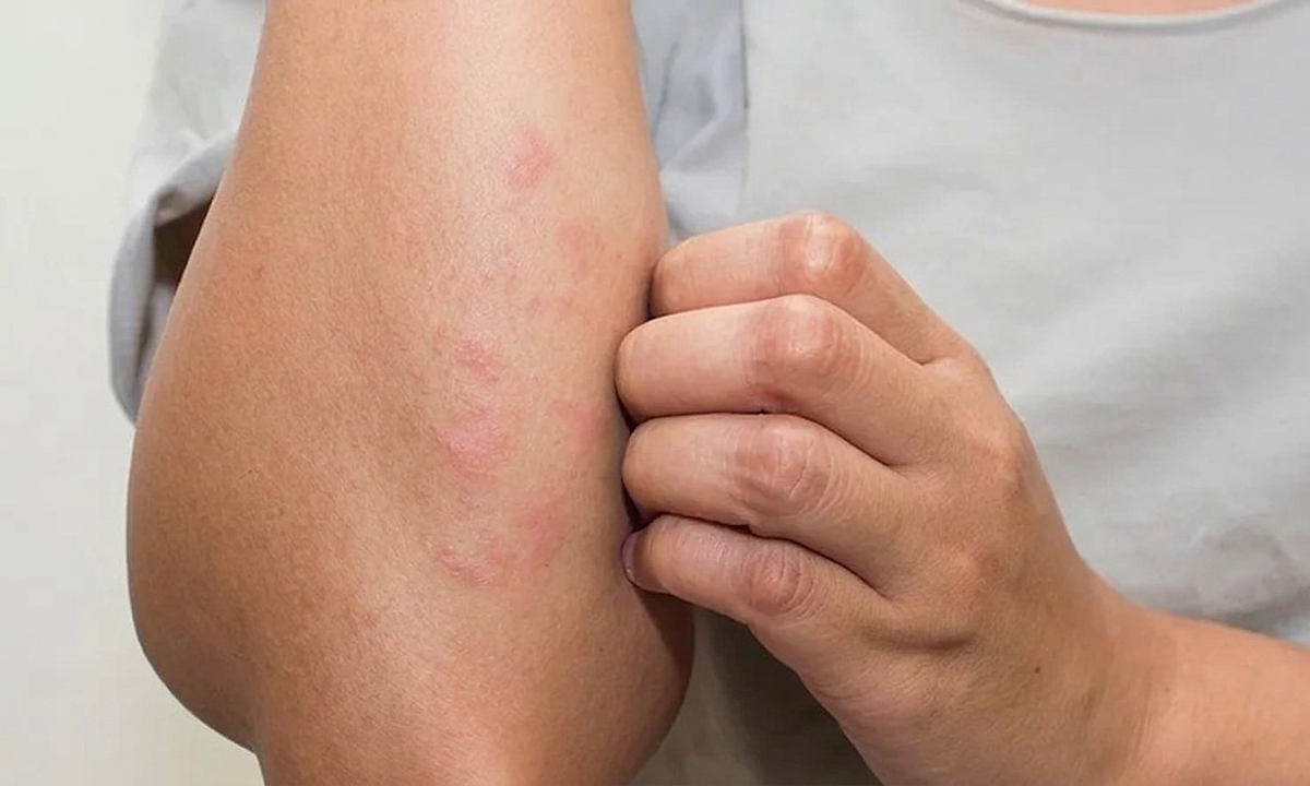 Dấu hiệu thay đổi trên da cảnh báo tiểu đường