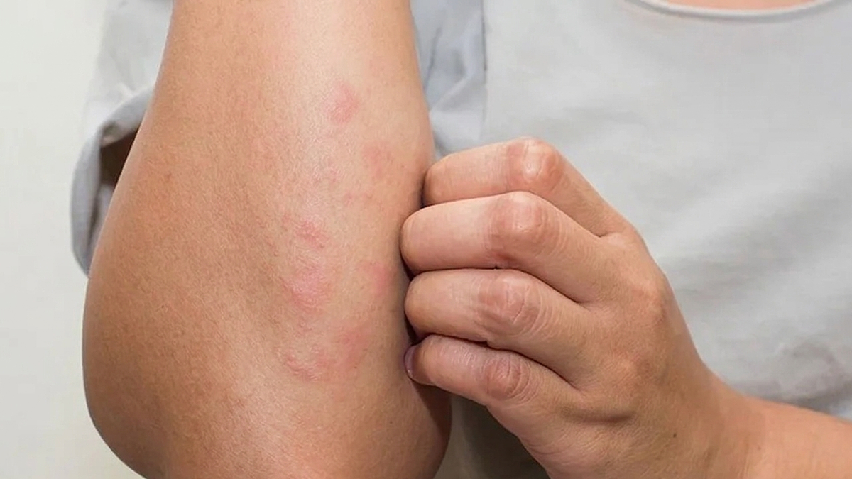 Dấu hiệu thay đổi trên da cảnh báo tiểu đường