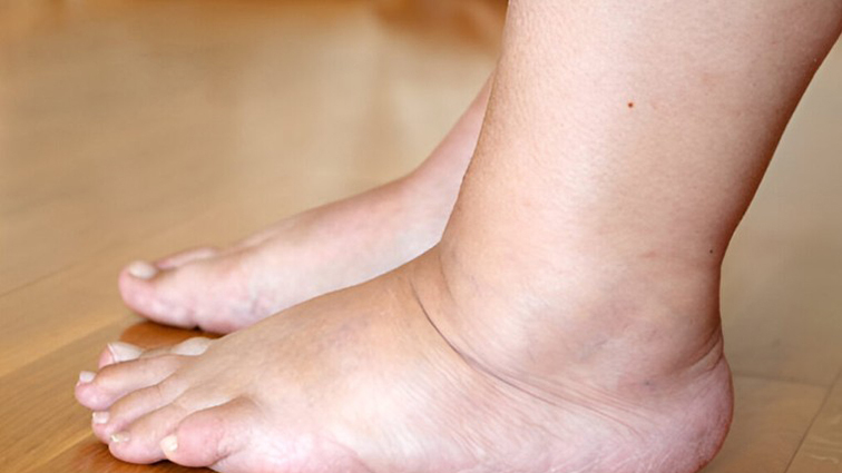 Bác sĩ Mỹ chỉ ra 5 dấu hiệu ở chân cảnh báo thận suy