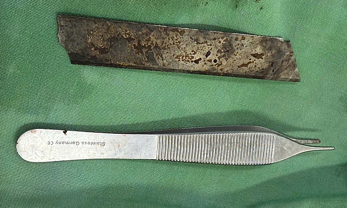 Cứu người đàn ông bị lưỡi dao máy cắt cỏ gãy văng xuyên bụng
