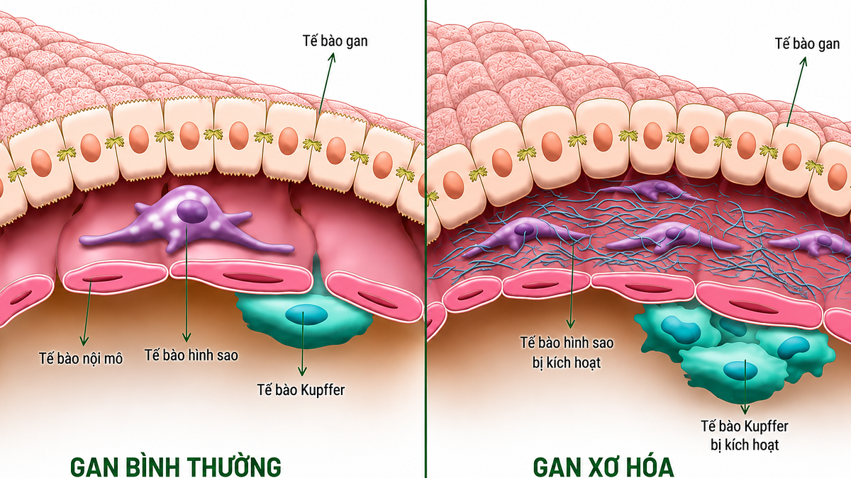 Cách đơn giản giảm men gan cao