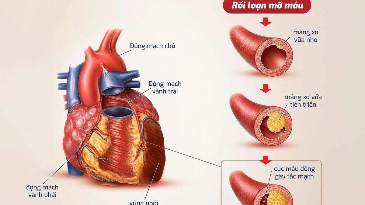 Vì sao rối loạn mỡ máu dù không triệu chứng?