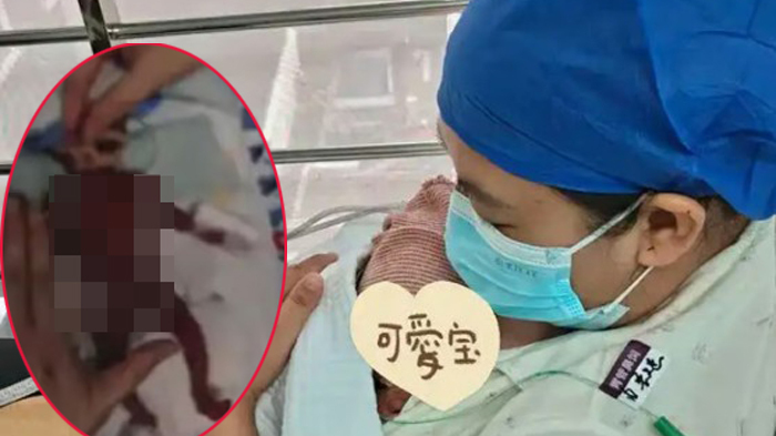 Kỳ tích xuất viện của em bé sinh non nặng 330 gram