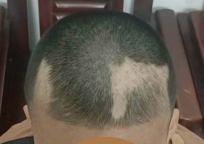 Bé trai 12 tuổi nhổ trụi từng mảng tóc vì áp lực ôn thi