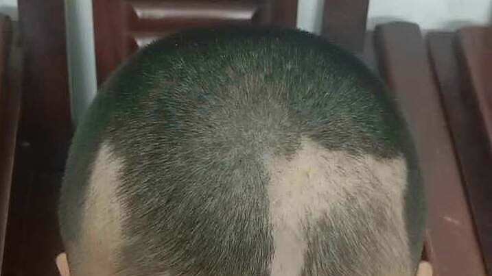 Bé trai 12 tuổi nhổ trụi từng mảng tóc vì áp lực ôn thi