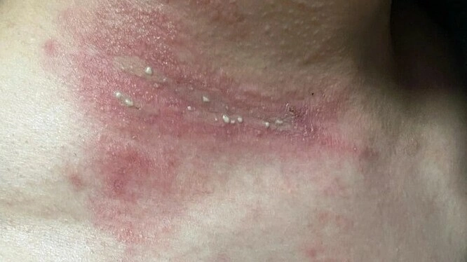 Bị kiến ba khoang cắn có nên tiêm vaccine?