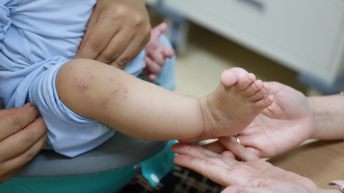 Bác sĩ hướng dẫn chăm sóc trẻ mắc tay chân miệng đúng cách