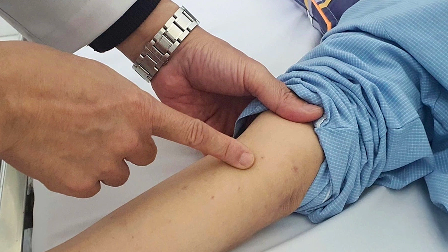 Khoảng trống miễn dịch khiến thanh thiếu niên dễ mắc não mô cầu