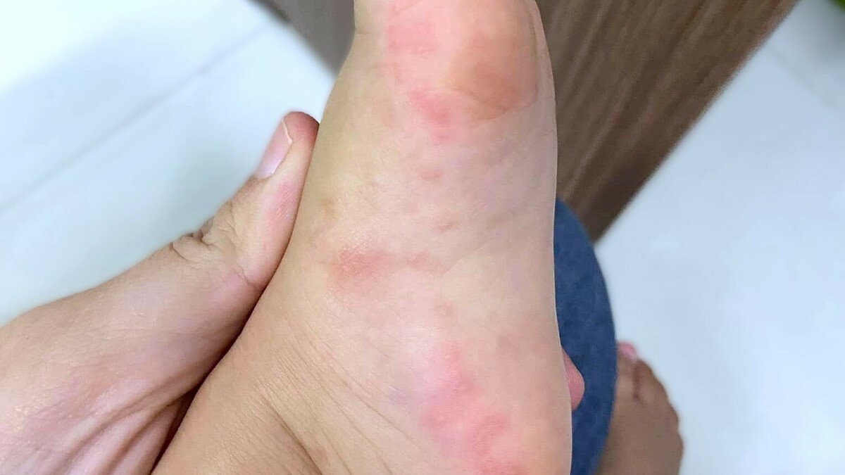 Trẻ khỏi tay chân miệng bao lâu sẽ tái nhiễm?