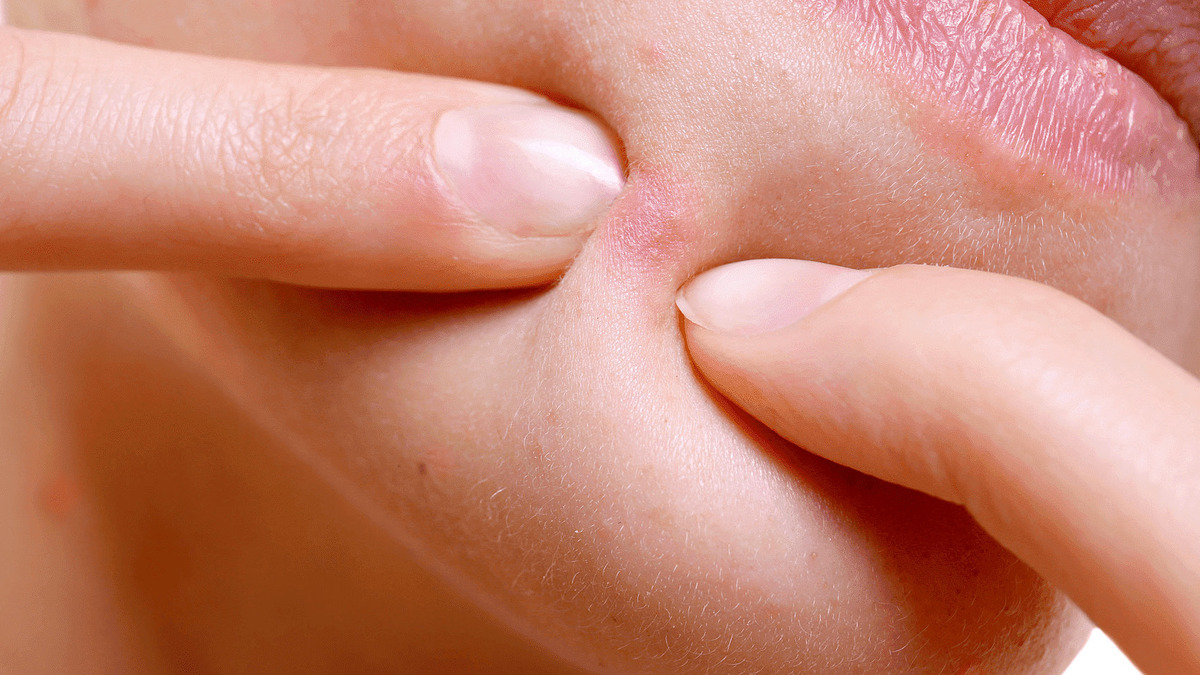 Mặt "sưng như ong đốt" vì làm đẹp cấp tốc trước ngày tựu trường