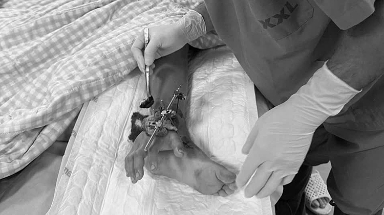 Bé trai bị cổng sập đè đứt chi được bác sĩ ghép tạm bàn tay vào chân