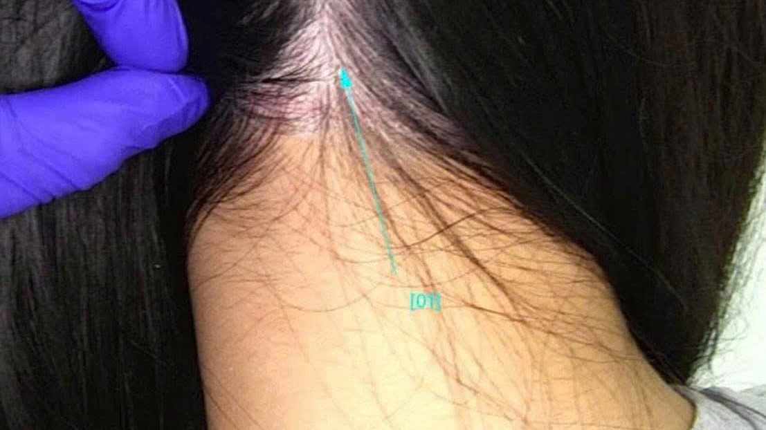 Vảy trắng đầu do viêm da mạn tính