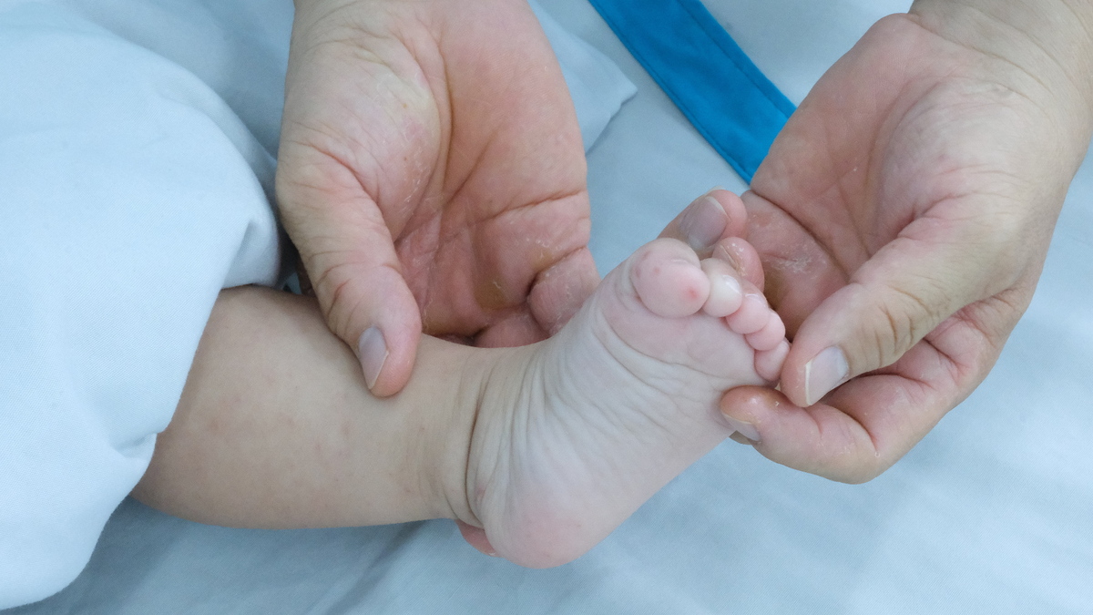 Dấu hiệu bệnh tay chân miệng dễ nhầm với côn trùng cắn
