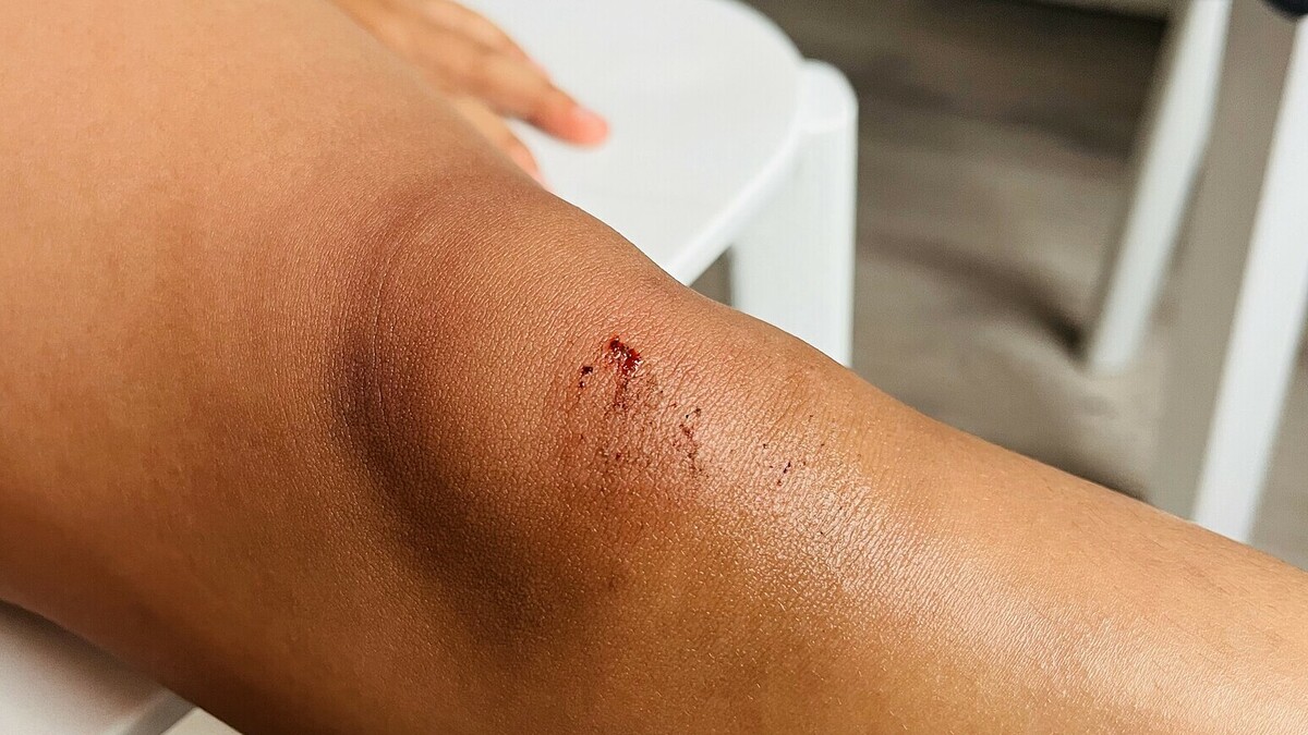 Những vết thương nhỏ tiềm ẩn nguy cơ nhiễm trùng