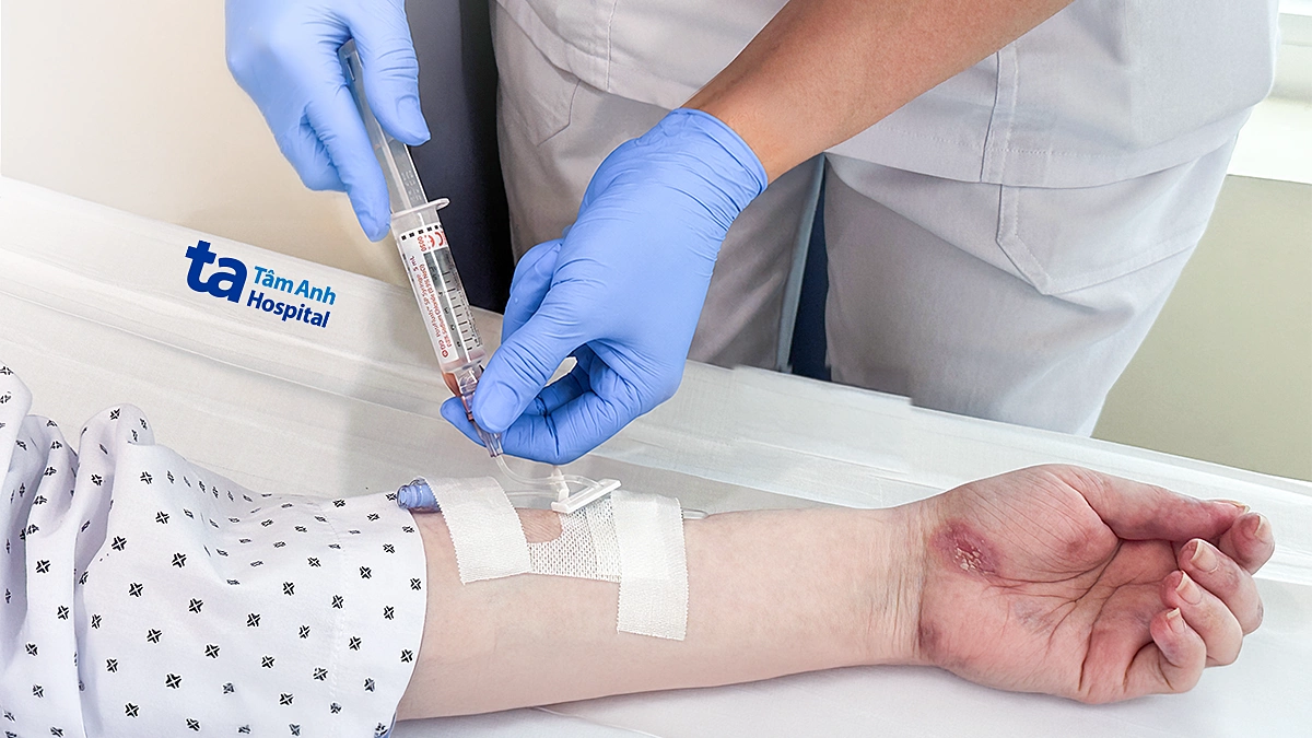 Truyền thuốc sinh học ngăn lupus ban đỏ bùng phát