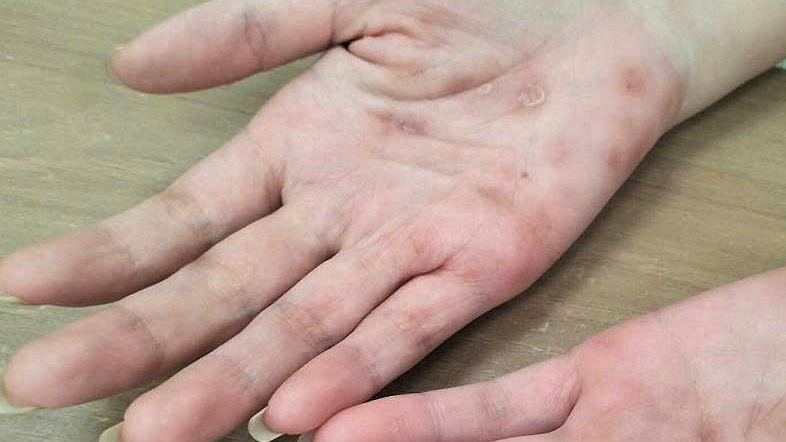 Từ nốt đỏ trong lòng bàn tay bất ngờ phát hiện giang mai