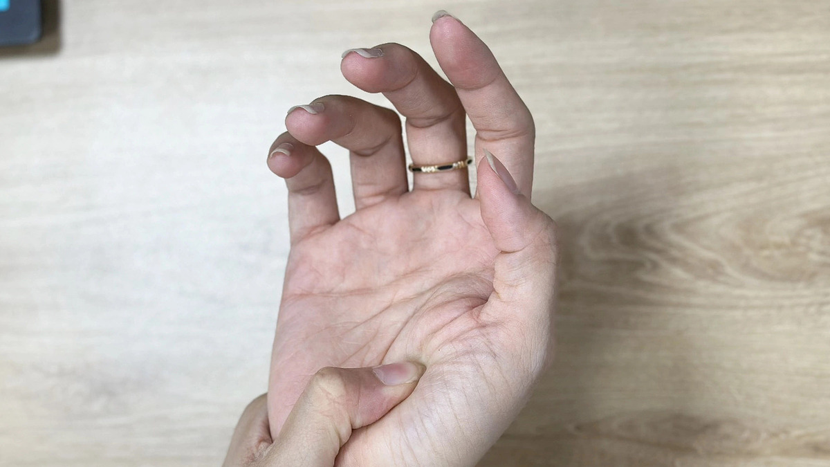 Tê nhức tay đột ngột do bệnh thần kinh nào?