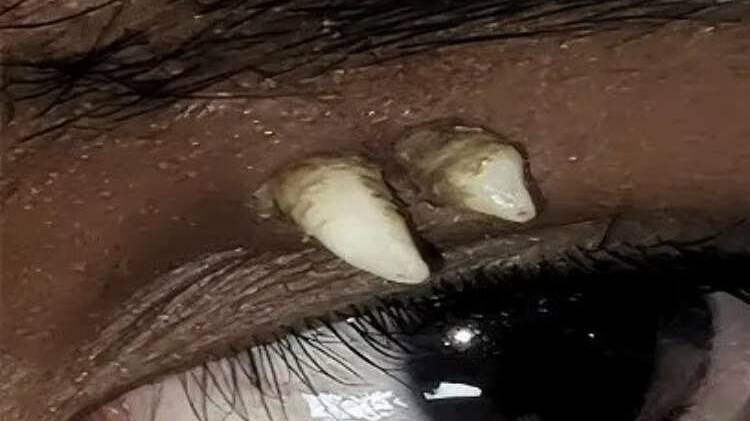 Ca răng mọc trong hốc mắt lần đầu xuất hiện trong y văn thế giới