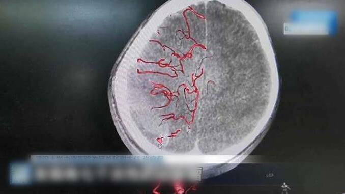 Bé trai 10 tuổi liệt nửa người sau khi tự nhổ răng sâu