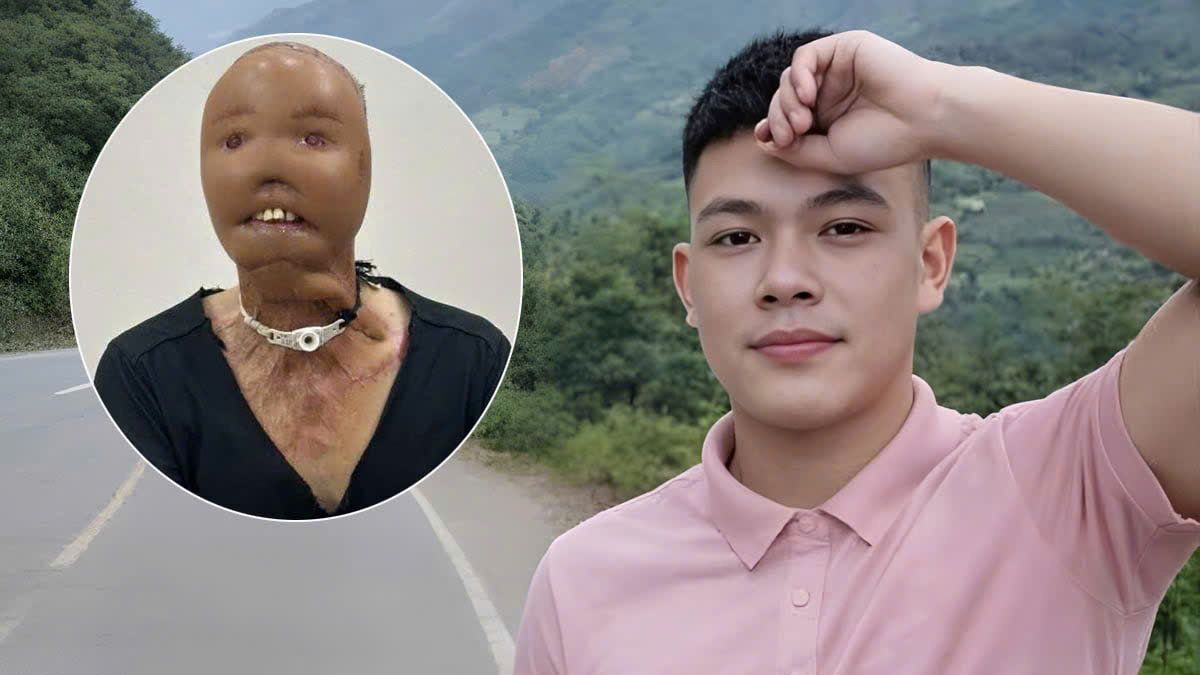 Hành trình tìm lại diện mạo của chàng trai mất mặt vì nước sôi