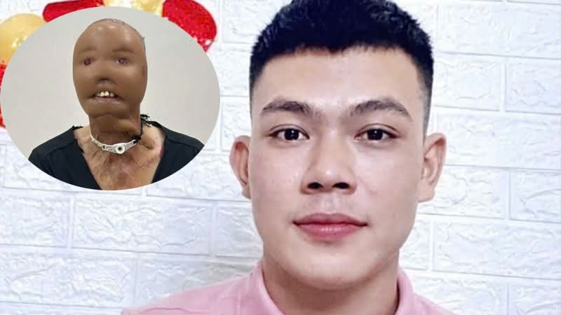 Nghị lực của chàng trai mất mặt vì bỏng nước sôi