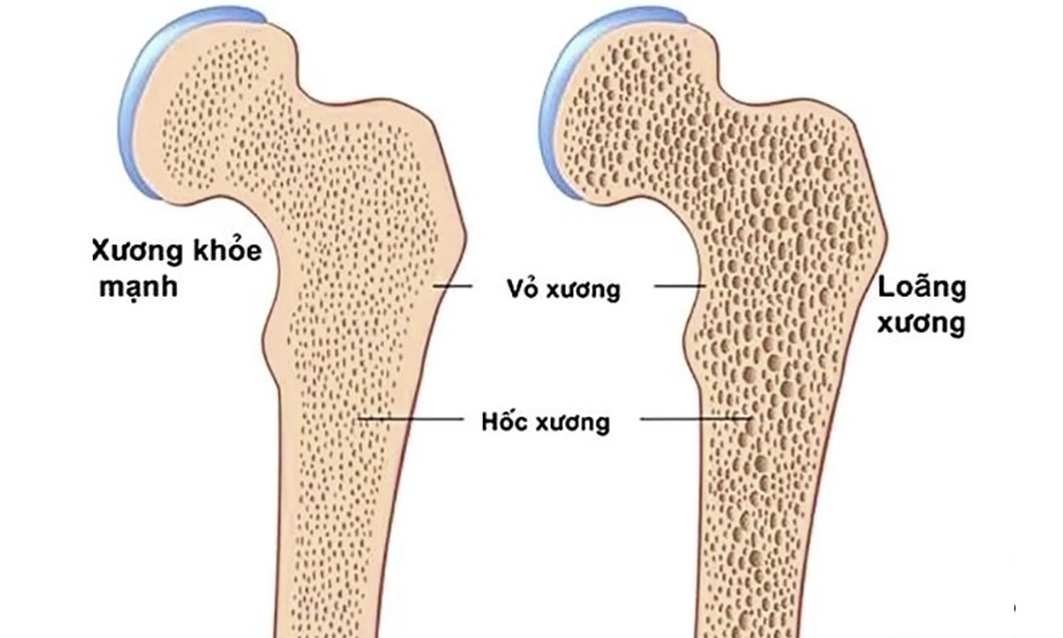 Loãng xương - mối nguy âm thầm rình rập phụ nữ sau tuổi 40
