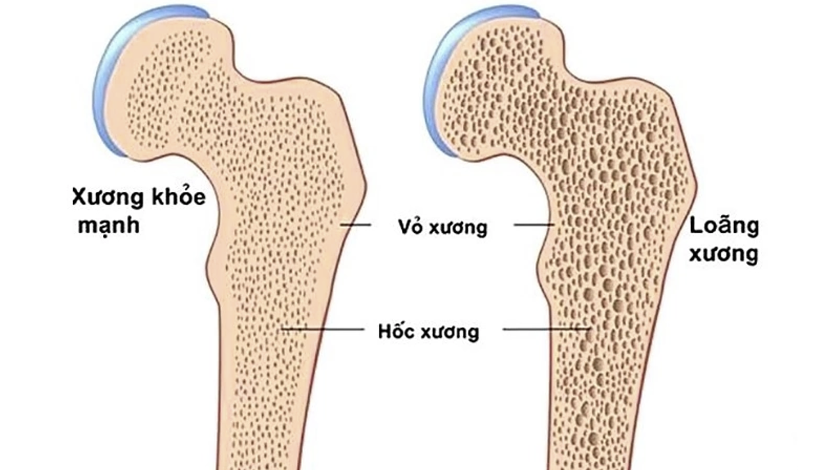 Loãng xương - mối nguy âm thầm rình rập phụ nữ sau tuổi 40