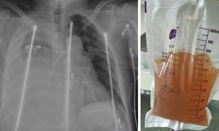 Bác sĩ hút 2,5 lít nước tiểu mỗi ngày từ ngực người phụ nữ sau tai nạn