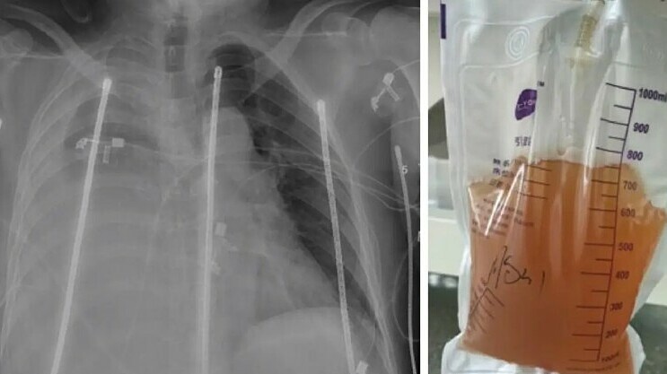 Bác sĩ hút 2,5 lít nước tiểu mỗi ngày từ ngực người phụ nữ sau tai nạn