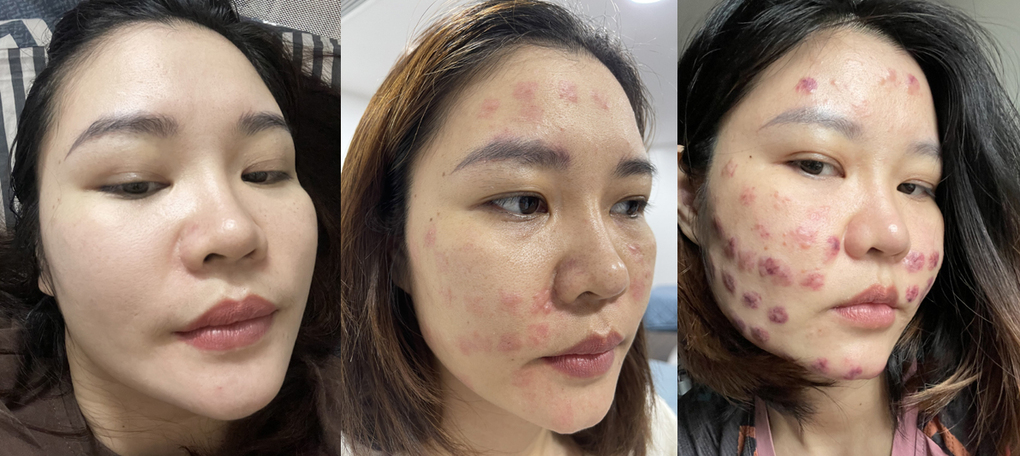 Bốn năm chữa mặt biến dạng vì mũi tiêm meso 'trôi nổi'