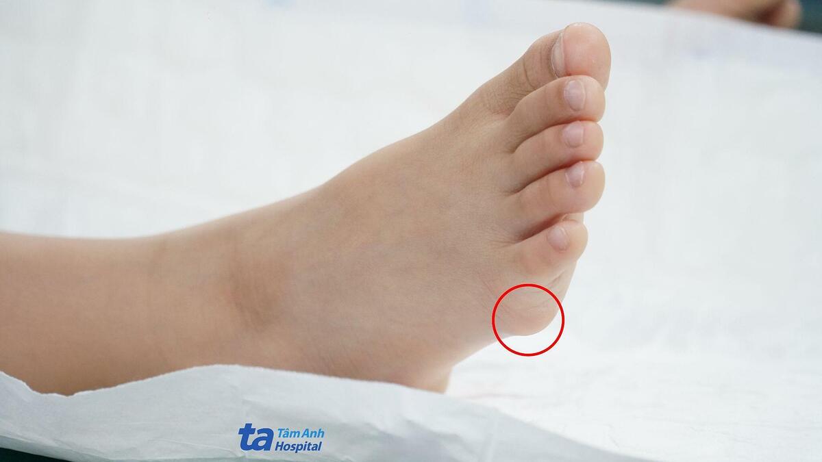 Kén thượng bì dưới bàn chân bé trai