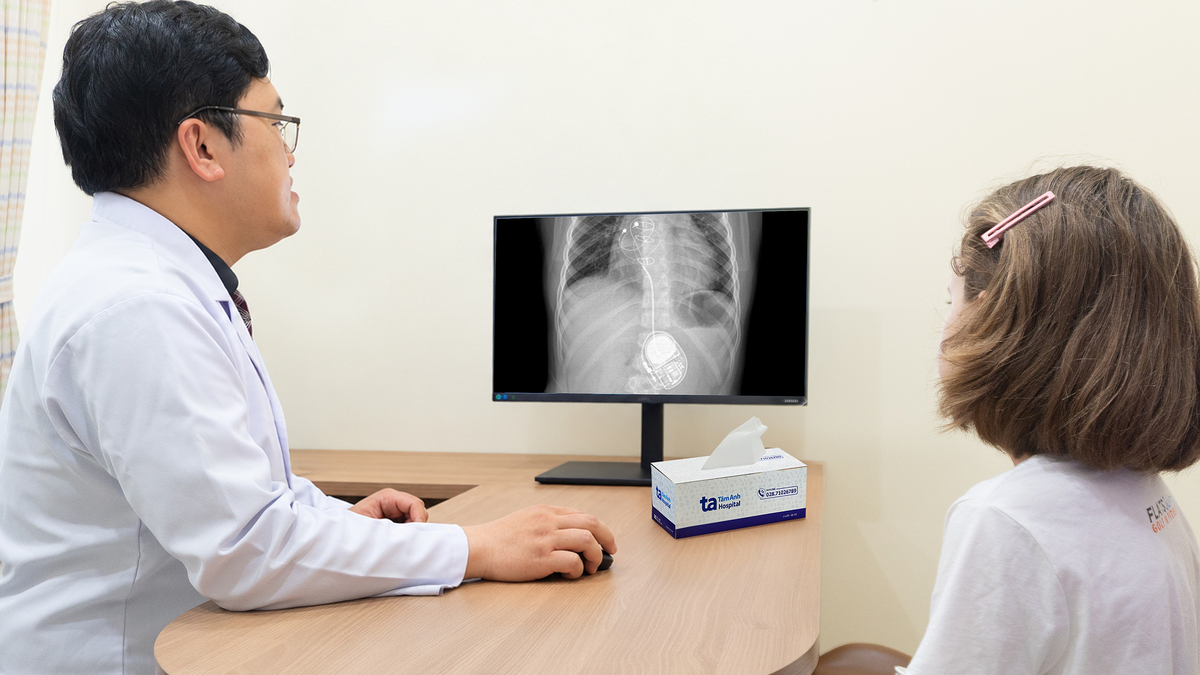 Thay máy tạo nhịp tim cho bé gái 8 tuổi